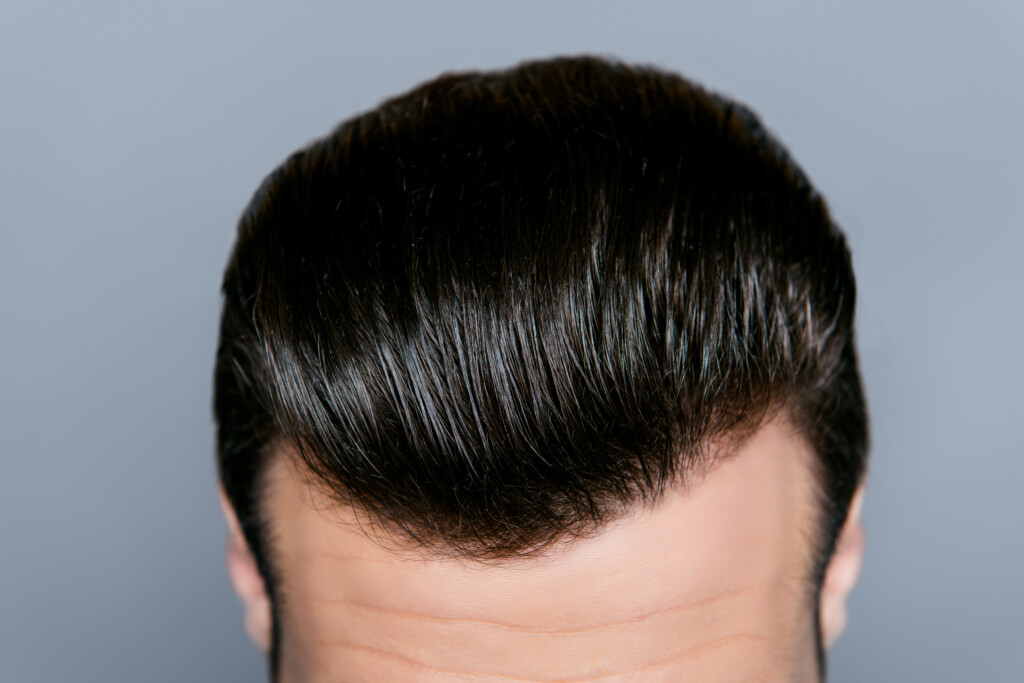 trapianto capelli