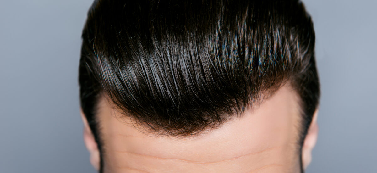 trapianto capelli